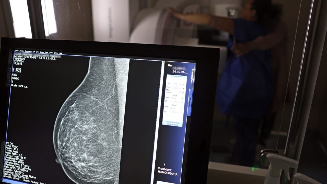 Entidades alertam médicos sobre pedidos de mamografia digital